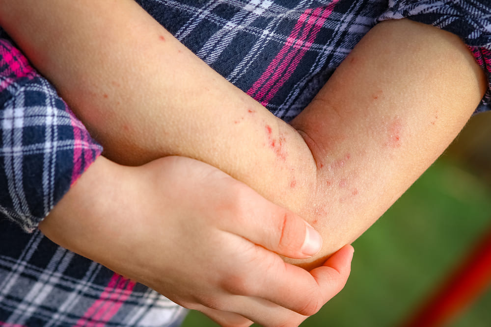 Как лечат атопический дерматит у детей