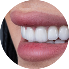 Коронки E-max