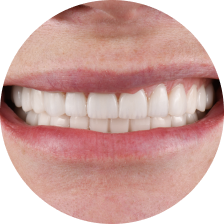 Культевая вкладка из диоксида циркония Культевая вкладка из диоксида циркония