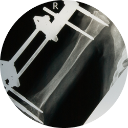 Результат остеосинтеза плечевой кости Результат остеосинтеза плечевой кости