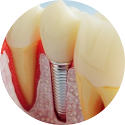 Одномоментная имплантация