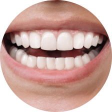 Коронка на зуб CEREC