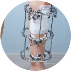 Остеосинтез с применением аппарата Илизарова Результат операции остеосинтеза