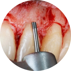 Резекция верхушки корня