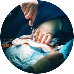 Результат после пангистерэктомии