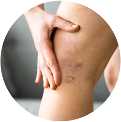 Результат операции Результат склеротерапии вен