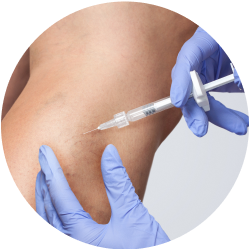 Реабилитация после склеротерапии вен Восстановление после склеротерапии вен