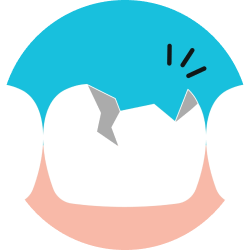 Сколы переднего зуба