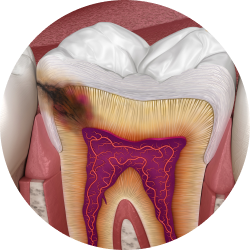 Острый кариозный процесс Острый кариозный процесс