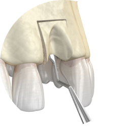 Пересадка костного блока