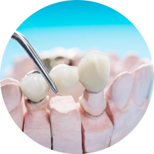 Металлические коронки Металлические коронки