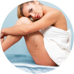 Восстановление после удаления сосудистых звёздочек на ногах лазером