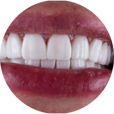 Мостовидные зубные протезы из диоксида циркония