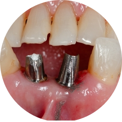 Классическая (двухэтапная) имплантация Классическая (двухэтапная) имплантация