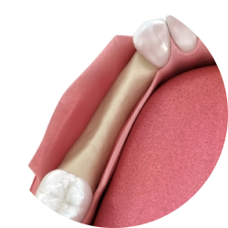 Направленная костная регенерация