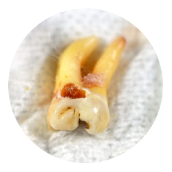 Удаление ретинированного зуба