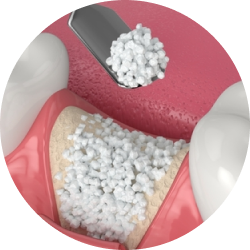 Расщепление альвеолярного гребня