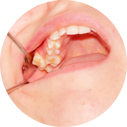 Простое удаление