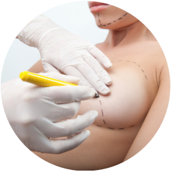 Результат операции Результат коррекции сосково-ареолярного комплекса