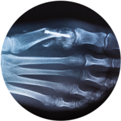 Результат удаления косточки на большом пальце ноги Результат удаления косточки на большом пальце ноги