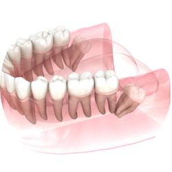 Сложное удаление