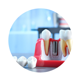 Временные коронки