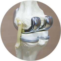 Результат операции эндопротезирования коленного сустава 