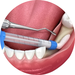 Межкортикальная остеотомия (расщепление альвеолярного гребня)